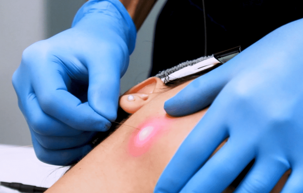 Endolifting: El Lifting sin Cirugía que Transforma tu Piel